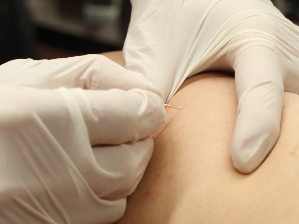 Dry Needling