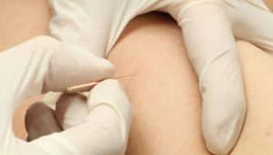 Dry Needling